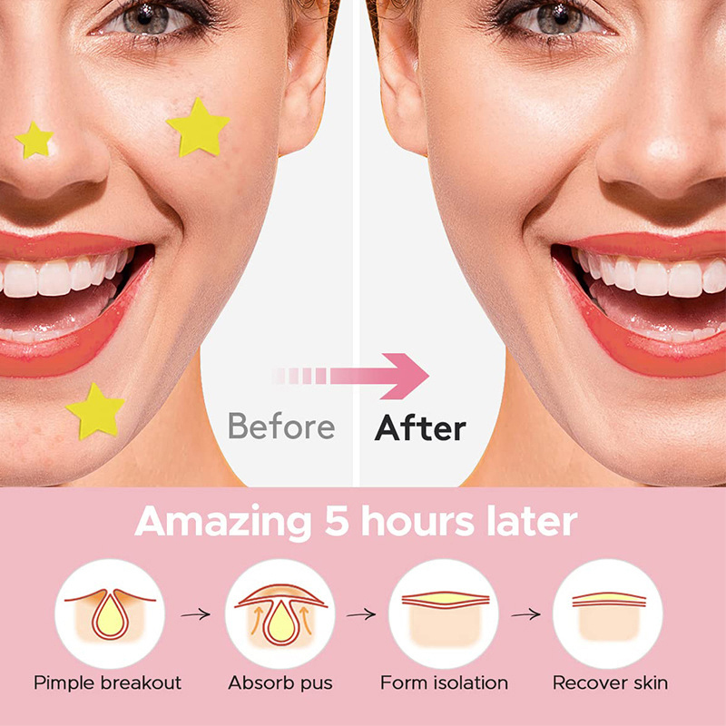 600Pcs/set Plester Jerawat Bin - Beauty Of Makeup ulasan dan harga